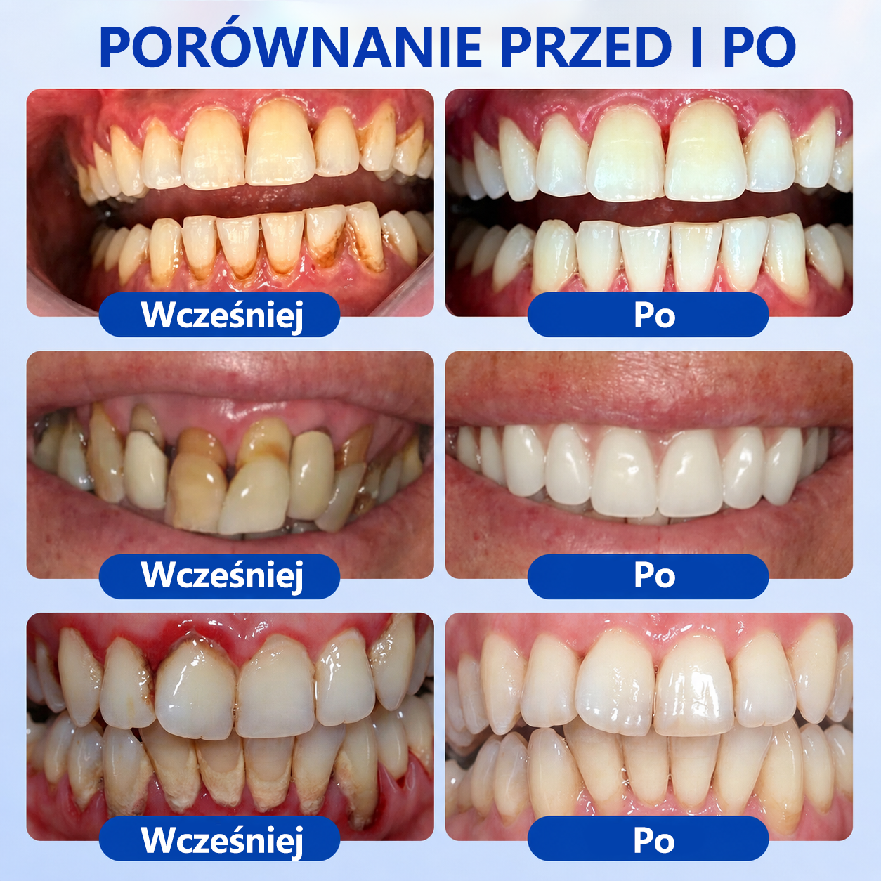 Przełomowe rozwiązanie do regeneracji jamy ustnej 🇵🇱🏅🦷 PureShade® GumRevive Żel do regeneracji przyzębia ⚡