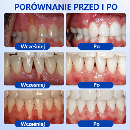 Przełomowe rozwiązanie do regeneracji jamy ustnej 🇵🇱🏅🦷 PureShade® GumRevive Żel do regeneracji przyzębia ⚡
