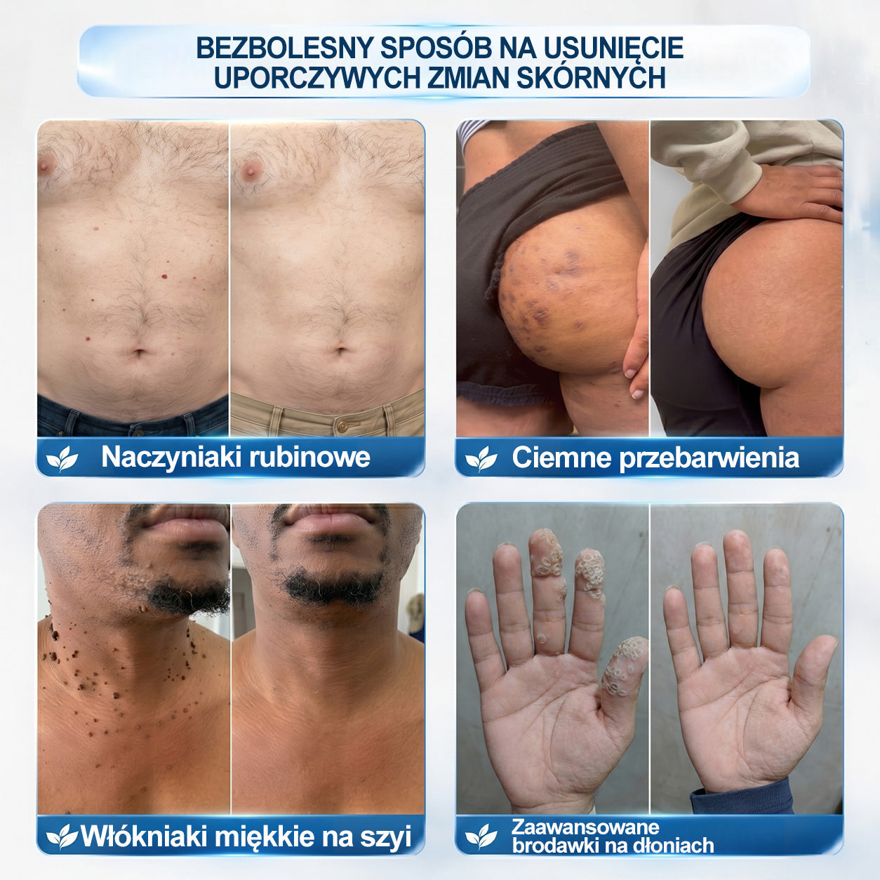 🍀👨‍⚕️👨‍⚕️Hiskin® 7 𝑫𝒏𝒊 𝑷𝒓𝒆𝒑𝒂𝒓𝒂𝒕 𝑫𝒐 𝑼𝒔𝒖𝒘𝒂𝒏𝒊𝒂 𝑾łó𝒌𝒏𝒊𝒂𝒌ó𝒘 𝑴𝒊ę𝒌𝒌𝒊𝒄𝒉 𝑰 𝑷𝒓𝒛𝒆𝒃𝒂𝒓𝒘𝒊𝒆ń(𝐁𝐞𝐳 𝐁ó𝐥𝐮, 𝐁𝐞𝐳 𝐁𝐥𝐢𝐳𝐧 – 𝐑𝐨𝐥𝐥-𝐨𝐧)