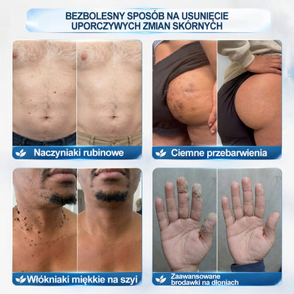 🍀👨‍⚕️👨‍⚕️Hiskin® 7 𝑫𝒏𝒊 𝑷𝒓𝒆𝒑𝒂𝒓𝒂𝒕 𝑫𝒐 𝑼𝒔𝒖𝒘𝒂𝒏𝒊𝒂 𝑾łó𝒌𝒏𝒊𝒂𝒌ó𝒘 𝑴𝒊ę𝒌𝒌𝒊𝒄𝒉 𝑰 𝑷𝒓𝒛𝒆𝒃𝒂𝒓𝒘𝒊𝒆ń(𝐁𝐞𝐳 𝐁ó𝐥𝐮, 𝐁𝐞𝐳 𝐁𝐥𝐢𝐳𝐧 – 𝐑𝐨𝐥𝐥-𝐨𝐧)